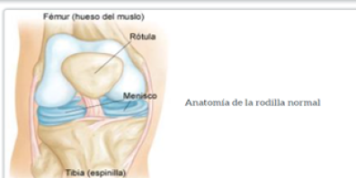 Desgarros de los meniscos