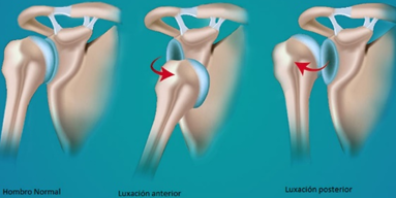 Inestabilidad de Hombro (Glenohumeral)