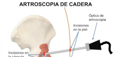 ARTROSCOPIA DE CADERA