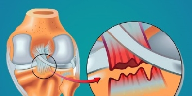 LESION DEL LIGAMENTO CRUZADO POSTERIOR