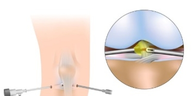 LESION DEL LIGAMENTO CRUZADO POSTERIOR