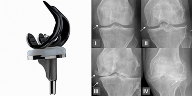 DESGASTE DE RODILLA